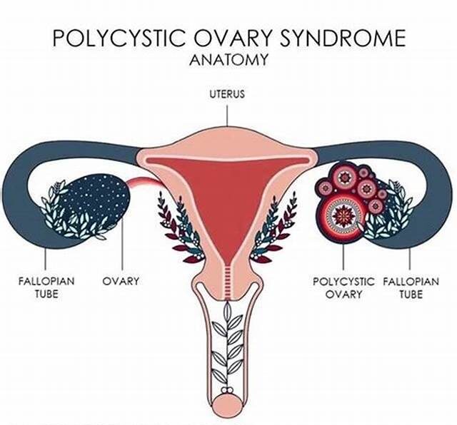 Polycystic Ovary Syndrome